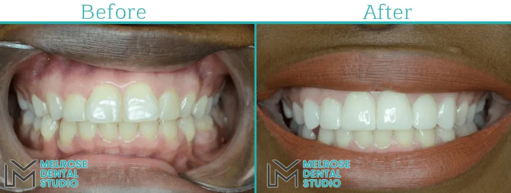 Smile makeover with porcelain veneers at Melrose Dental Studio, before and after, case 7
